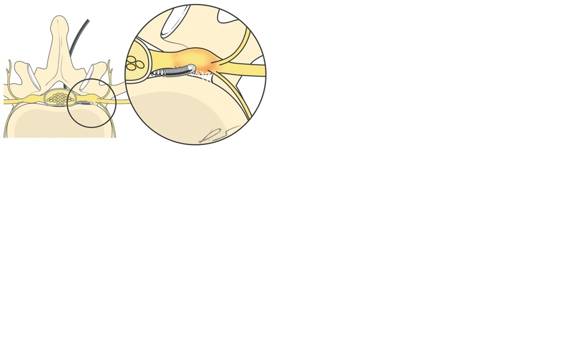 Nöroplasti (Epidural Lizis): Ameliyatsız Bel Fıtığı Tedavisi