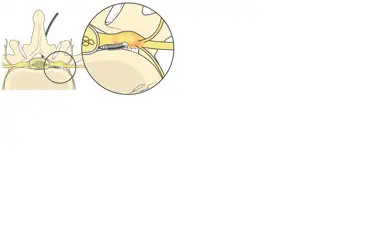 Nöroplasti (Epidural Lizis): Ameliyatsız Bel Fıtığı Tedavisi